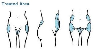 Coolsculpting resultats